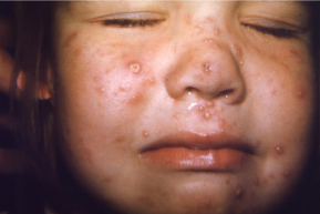<ul><li><p>enveloped dsDNA, herpesviridae</p></li><li><p>chicken-pox; <u>limb hypoplasia</u>, cicatricial skin lesions, ocular abnormalities, cortical atrophy</p><ul><li><p>multinucleated giant cell</p></li></ul></li></ul><p></p>