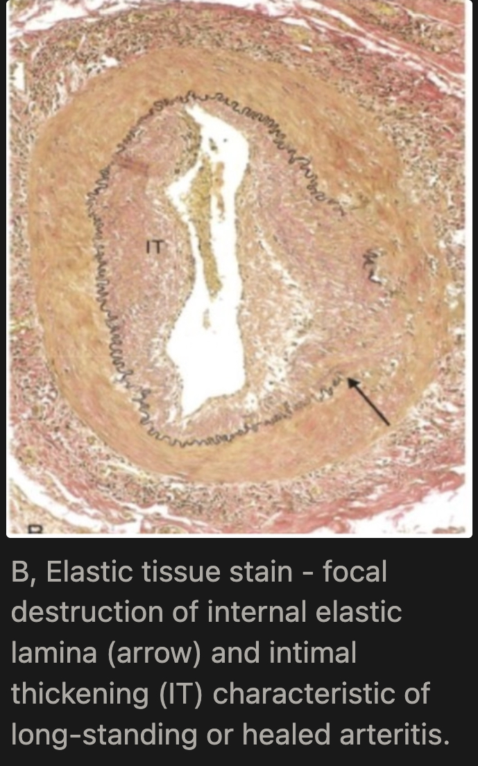<p>Medial scarring, intimal thickening, and residual elastic tissue fragmentation (seen on elastic tissue stain), followed by fibrosis → permanent vessel wall changes</p>