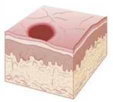 <p>size of a pin head to several centimeters</p><p><span style="color: red;">flat</span> well circumscribed colored area of tissue that varies in size color &amp; shape</p>