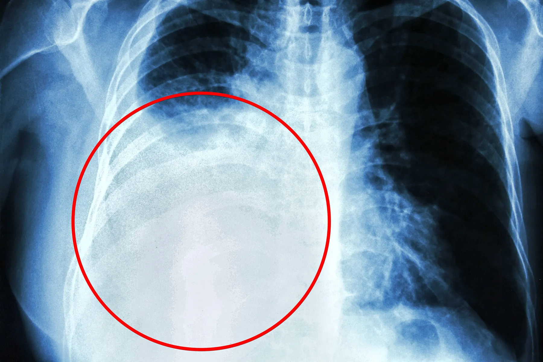 <p>Fluid in lungs. Costophrenic angles appear blunt, not sharp</p>