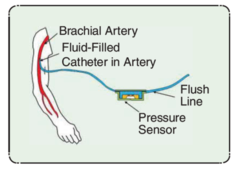 <p>invasive procedure of inserting catheter into an artery</p><p>continuous measurement and arterial waveforms</p><p>used in critical care setting</p>