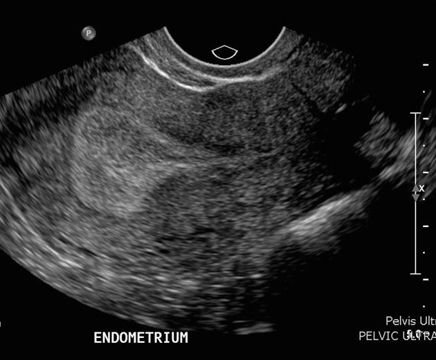 <p><span>What endometrial phase do we see in this image?</span></p>