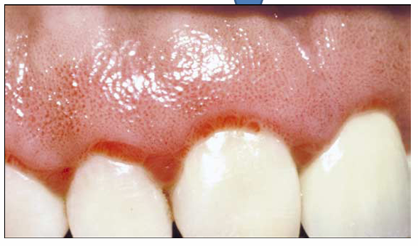<p>1.what is this lesion?</p><p>2. how to treat/ manage it?</p><p>3. classification of oral lesion in HIV?</p><p></p>