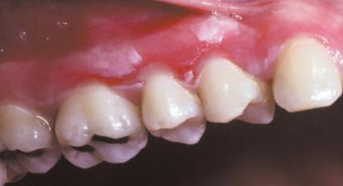 <p>chemical burn </p>