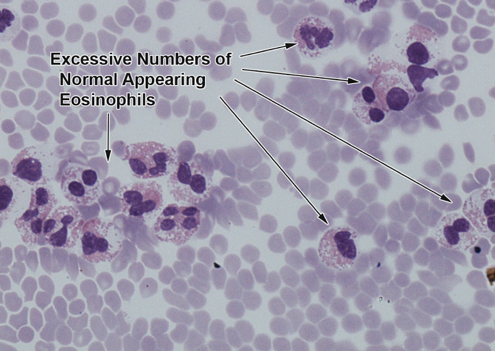 <p><span style="background-color: rgba(0, 0, 0, 0); line-height: 19.55px;">Eosinophilic Leukemia (Eosinophilia)</span></p>