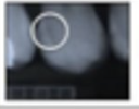 <p>radiolucency in the outer 1/3 of dentin</p>