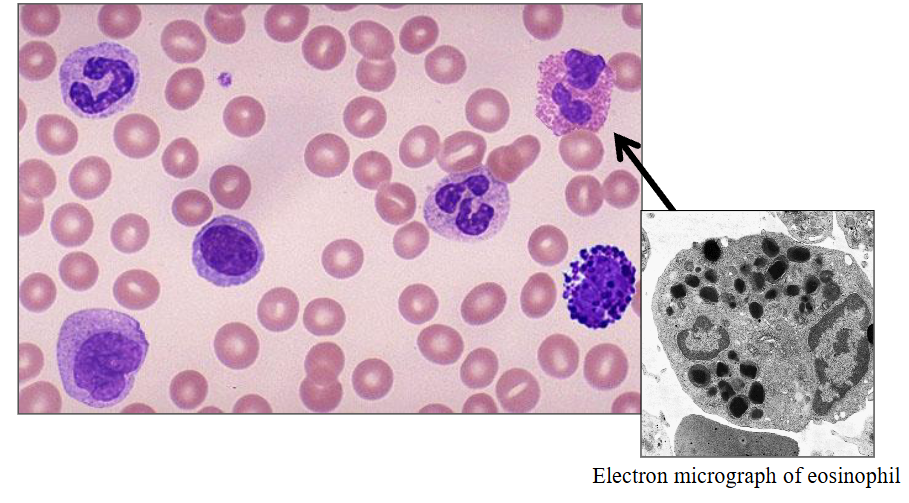<p>- eosinophils are slightly larger then a neutrophil</p><p>- the granules are orange (or eosinophillic)</p><p>- one segment of the nucleus and another and these really large granules, much larger then in a neutrophil and more of them</p>