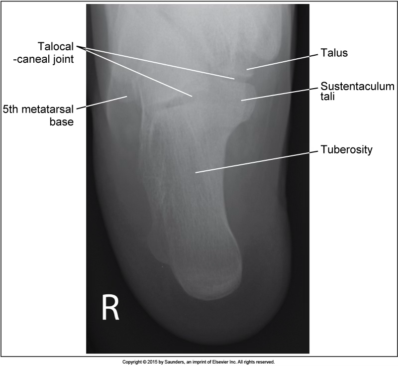 <p>Axial calcaneus</p>