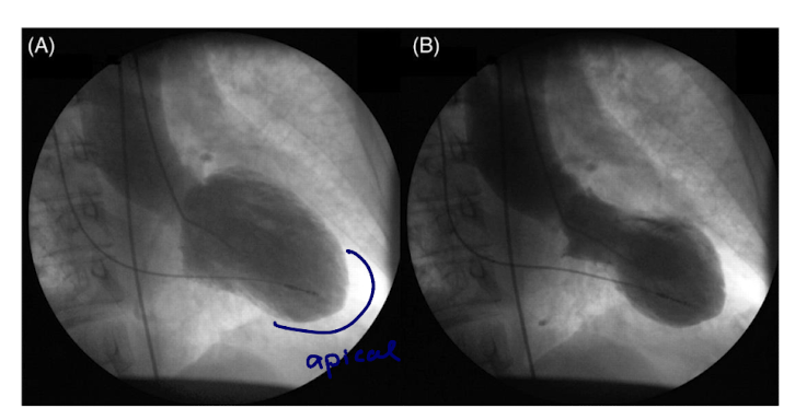 <p>a stress induced, acute cardiac syndrome</p><p>stress is often emotional in origin</p><p>much more prevalent in women </p><p>apical akinesis is typical (apical region doesn’t move)</p>