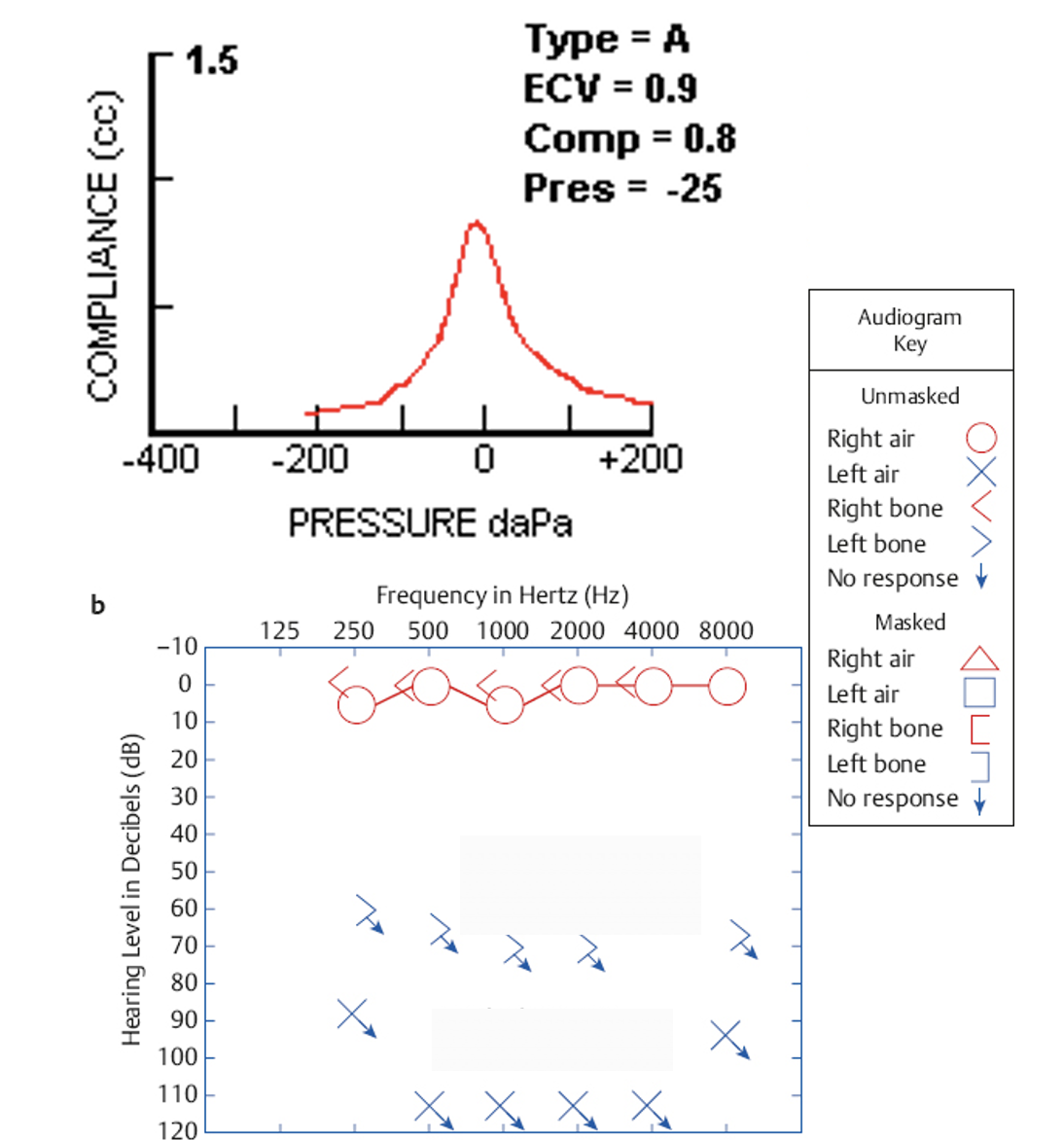 <p><span>Loud ringing in left ear</span></p><p style="text-align: left;"><span>Straining behavior to speech in left ear</span></p><p style="text-align: left;"><span>SRT left: 70 dB. Responded with several half-spondees</span></p>