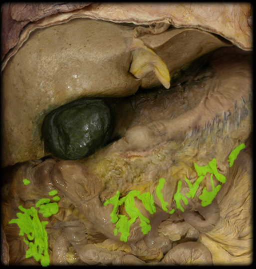 <p><span>Omental appendices</span></p>