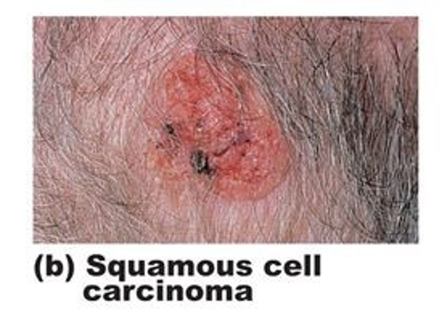 <p>firm REDDISH appearing lesion</p><p>-often emerging in sun exposed areas</p><p>-feels rough or keratonic</p><p>-crusty, scaly, ulcerated</p><p>-can metastasize</p>