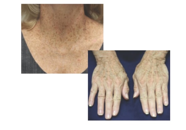 <p>Bilat Symmetric; brown macule (<1cm flat area of color change) on sun exposed skin </p><p><em>not freckle</em></p>