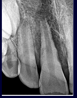 <p>-immediate complication</p>