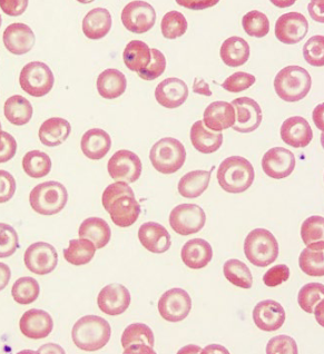 <p>This is a mammalian blood smear. The red blood cells in the picture do <strong>OR </strong>do not have nuclei. The biconcave shape gives mammal RBCs a lower <strong>OR</strong> greater surface area-to-volume ratio than in bird RBCs.</p>