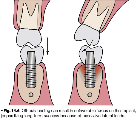 <p><span>(loads directed through the long axis of the implants)</span></p>