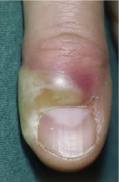 <p>What does this refer to</p><ul><li><p>Inflammation/infection involving the lateral and proximal fingernail folds (the cuticle)</p><p></p></li></ul><p></p>