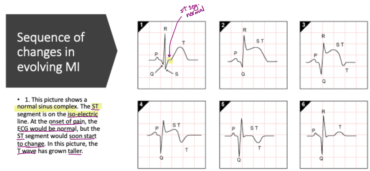 <p><strong>Normal sinus complex</strong> or <strong>hyperacute T-wave changes</strong> (<em>increased</em> amplitude/width)</p>