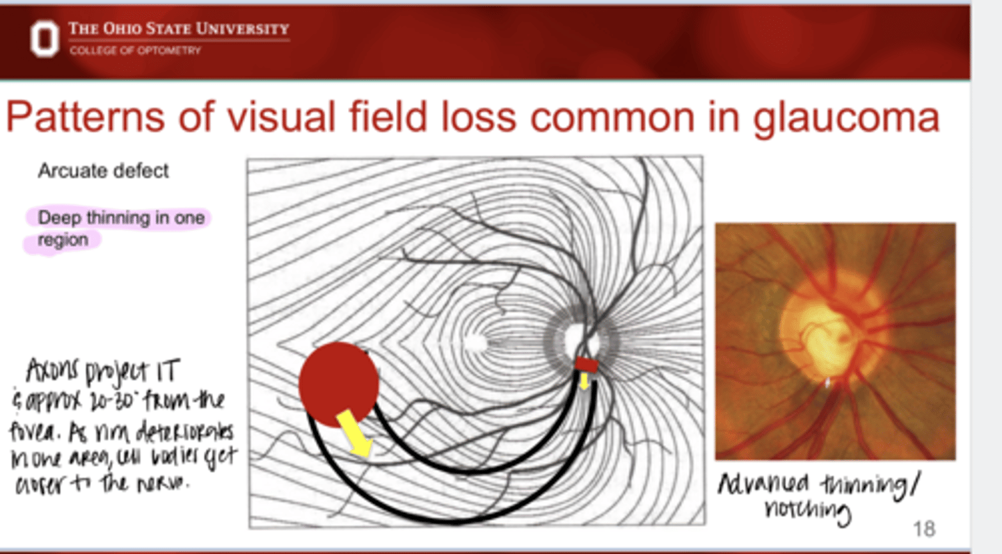 <p>What is the characteristic appearance of a arcuate defect on VF?</p>