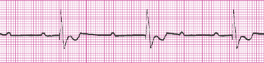 <ul><li><p><span style="background-color: transparent;">Atria and ventricles are working independently</span></p></li><li><p><span style="background-color: transparent;">SA node fires at a constant rate (60-100)</span></p></li><li><p><span style="background-color: transparent;">Ventricles don't receive impulse so AV junction takes over and fires impulses (15-60)</span></p></li><li><p><span style="background-color: transparent;">P-P is regular and QRS-QRS is regular, no correlation</span></p></li><li><p><span style="background-color: transparent;">Tx if symptomatic: pacer, dopamine</span></p><ul><li><p><span style="background-color: transparent;">Atropine does not work because the SA node does not talk to the AV node</span></p></li></ul></li></ul><p></p>