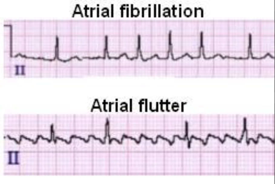 <p>what distinguishing factors set atrial fibrillation apart from atrial flutter on an EKG?</p>