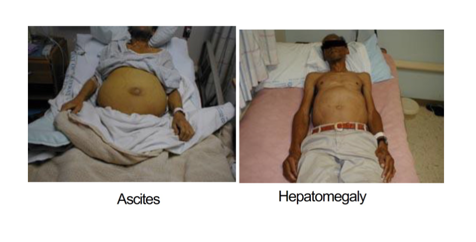 <p>Ascites and hepatomegaly are signs of </p>