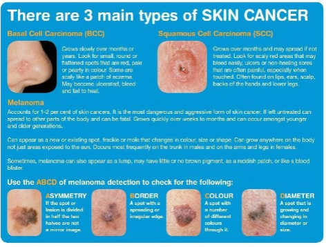 <p>Main Types of Skin Cancer</p>