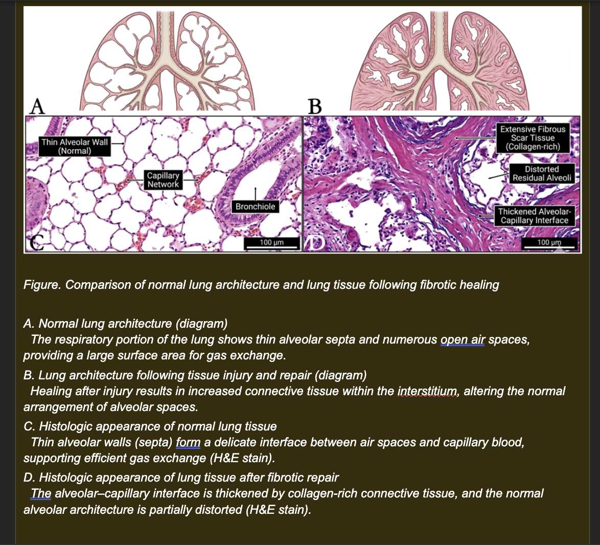 <p>A dog is presented with progressive respiratory signs -- tachypnea, exercise intolerance, and hypoxemia -- 8 weeks after recovering from severe pneumonia. Chest radiographs show increased density throughout the lung fields. Lung biopsy shows:</p><p>- Thickened alveolar walls with dense collagen deposition replacing the normal thin alveolar epithelium</p><p>- Partial obliteration of alveolar air spaces by the fibrous tissue</p><p>- The remaining open alveoli have normal-appearing type I pneumocytes and intact capillaries</p><p>- No active inflammation or infection identified</p><p></p><p><strong>Which interpretation best explains why this dog is hypoxemic despite having no active infection?</strong></p><p><span>a. The fibrous tissue increases alveolar wall strength, which paradoxically traps oxygen within alveolar spaces and prevents its release into the blood</span></p><p><span>b. The thickened fibrotic alveolar walls increase the diffusion distance between alveolar air and capillary blood, reducing the rate of oxygen transfer and producing hypoxemia -- despite intact capillaries and remaining open alveoli</span></p><p><span>c. The fibrotic tissue replaces capillaries, eliminating the blood supply needed to carry oxygen from the lung to the rest of the body</span></p><p><span>d. Fibrosis activates macrophages that consume oxygen in the lung tissue before it can reach capillary blood</span></p>
