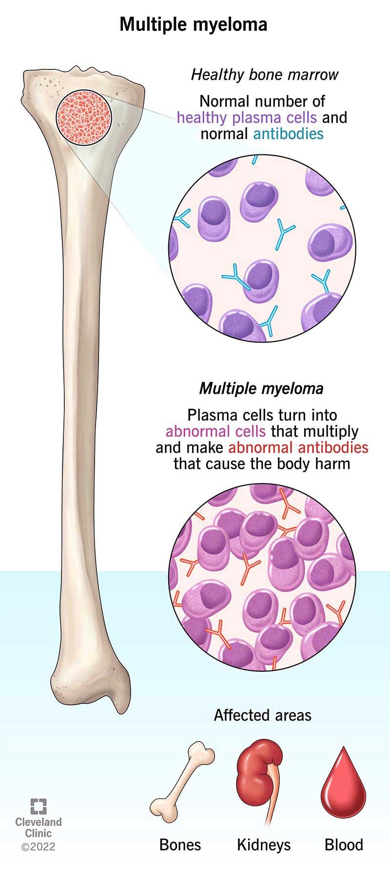 <p>Leukemia, lymphoma, and myeloma.</p><p>Example: Leukemia affects white blood cells.</p>