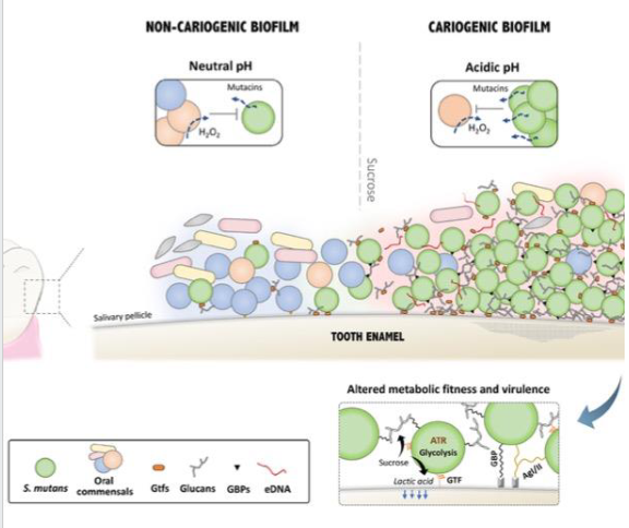 <p>- Continuous intake of sucrose (sugar) favours the growth of S. mutans</p><p>- S. mutans secretes glycosyltransferases (GTFs) which adsorb onto the enamel</p><p>- GTFs catabolise sucrose to produce large amounts of glucans, whcih contribute to the buildup of extracellular polysaccharide matrix which serves as a scaffold for biofilm</p><p>- Organic acids (e.g lactic acid) are produced by bacteria in the biofilm, decreasing pH</p><p>- the low pH leads to demineralisation of enamel and initiates the carious process</p><p>.</p><ul><li><p>Dental caries, or tooth decay, is a prevalent chronic disease where cariogenic bacteria metabolize sugars to produce acids, causing mineral loss and structural damage to teeth. It manifests as white spots, dark stains, sensitivity, and pain. Prevention involves fluoridated toothpaste, reduced sugar intake, and brushing, while treatment includes fillings, crowns, or root canals.</p></li></ul><p></p>