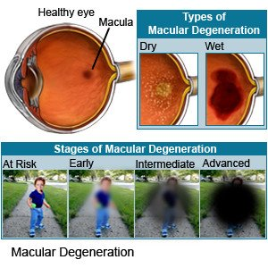<p>Deterioration of the macula</p><p></p>
