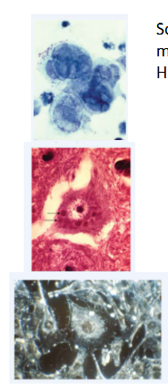 <p>- Some viruses cause the cells to form syncytia, which are large, multinucleate cells</p><p>- Herpes simplex virus-induced syncytia are shown here</p><p>.</p><p>- Other viruses cause abnormal internal structures visible when the host cells are stained; such inclusion bodies can form in the cytoplasm or nucleus, depending on the virus</p><p>- In most cases that have been investigated more closely, these inclusions turn out to be the sites of viral gene expression, genome replication, assembly or some combination of these</p><p>- Rabies virus inclusion bodies are visible in the cytoplasm; 2 are pointed out by arrows</p><p>- Transformed cancerous cells grow on top of eachother instead of responding to contact inhibitions as normal cells would. In the bottom image, the cells around the central one are piled on top of one another</p>