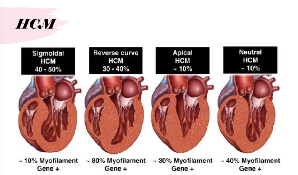 <ul><li><p>Reverse curvature</p></li><li><p>Sigmoid</p></li><li><p>Neutral</p></li><li><p>Apical</p></li><li><p>Mid-ventricular (kissing walls)</p></li></ul><p></p>