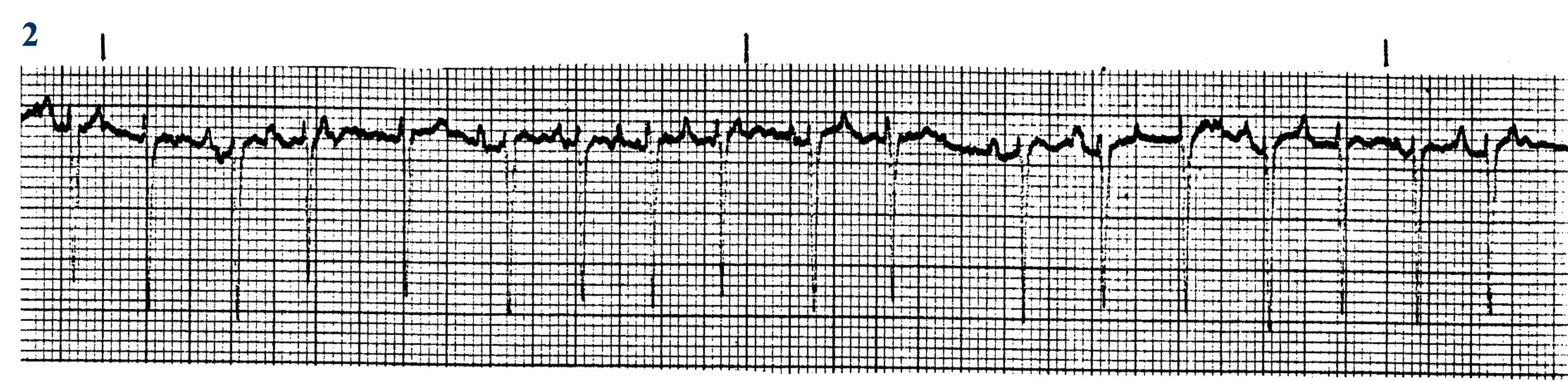 <p>What ECG is this? </p>