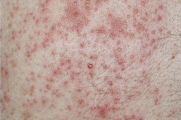 <ul><li><p>clusters</p></li><li><p>Ex: contact dermatitis </p></li></ul><p></p>