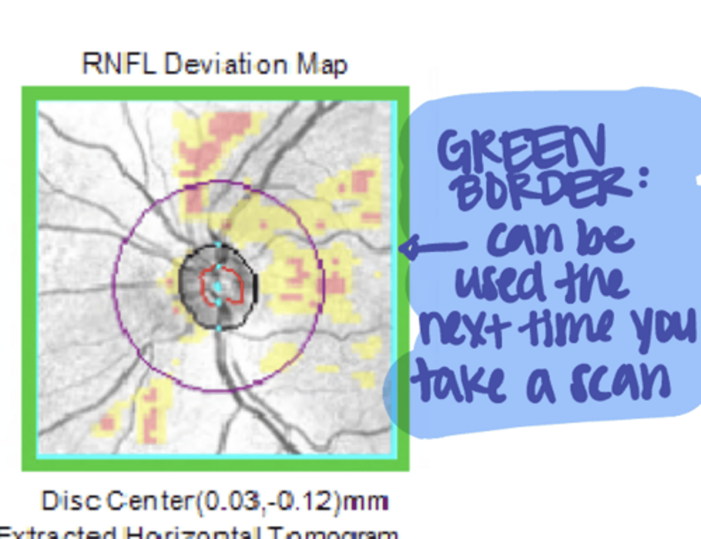 <p>What does the green border around the RNFL Deviation Map indicate on "ONH and RNFL OU Analysis"?</p>