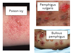 <ul><li><p>Poison ivy</p></li><li><p>Bullous disorders</p></li></ul><p></p>