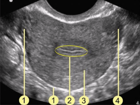 <p>Which uterine layer is #2?</p><p>a. Myometrium</p><p>b. Perimetrium</p><p>c. Cornua</p><p>d. Endometrium</p>