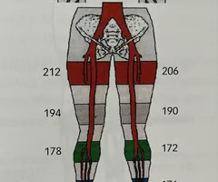 <p><span>Your next patient, Ms. Peters, presents to your department with a bluish discoloration of her right big toe. All pulses are palpable. She denies any history of pain in her legs with activity or pain that wakes her up at night. She has no risk factors associated with arterial disease. What do you suspect is the most likely cause of her problem?</span><br><br><span>A. Atherosclerosis</span><br><br><span>B. Aneurysmal disease</span><br><br><span>C. Raynaud's phenomenon</span><br><br><span>D. Coarctation of the aorta</span><br><br><span>E. Thromboangiitis obliterans</span></p><p></p>