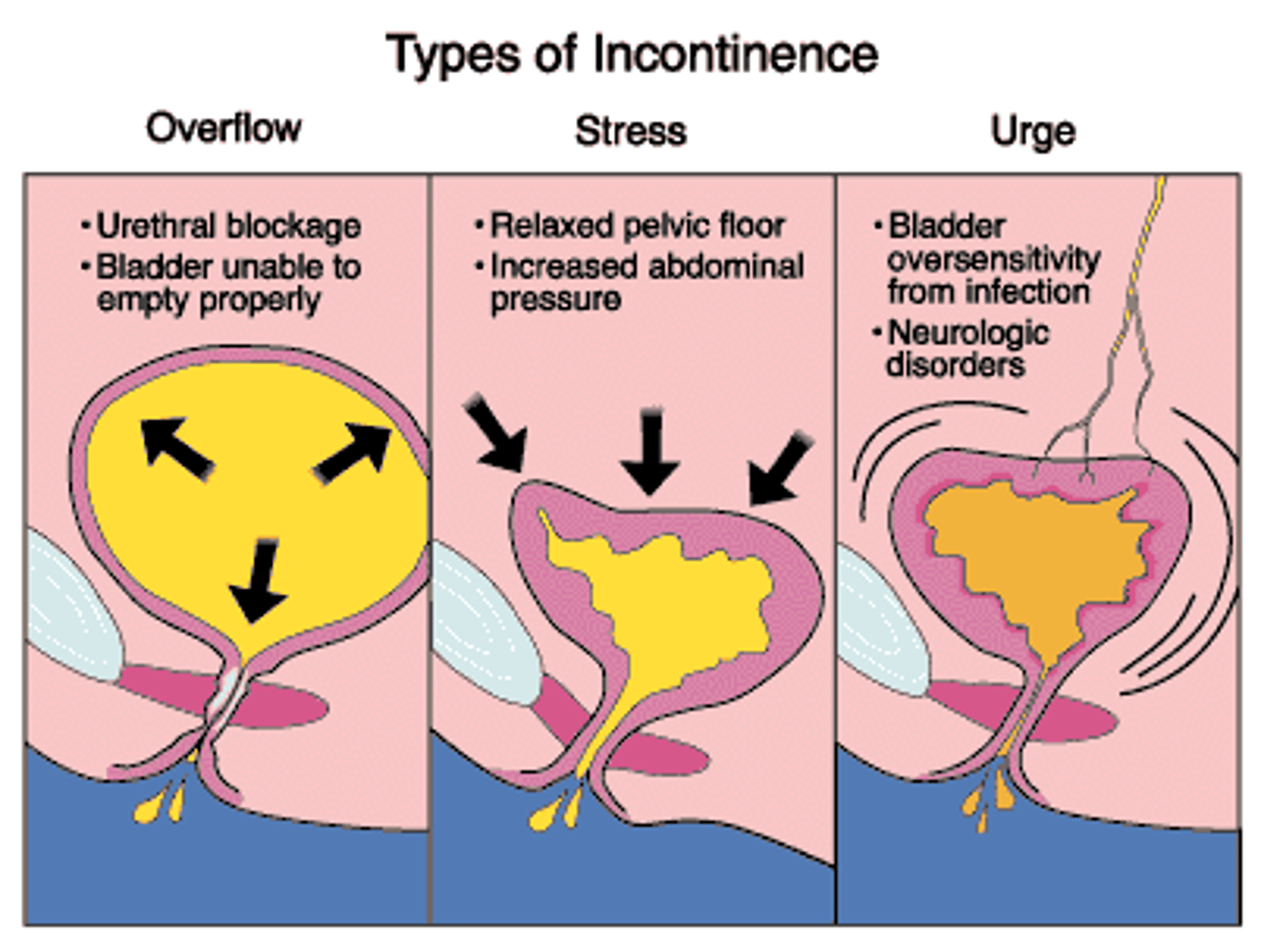 <p>bladder outlet obstruction (BPH)</p><p>spinal cord injuries</p><p>pelvic surgery</p>