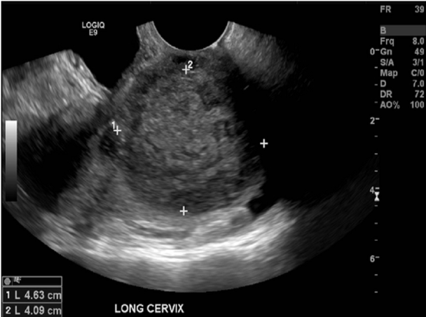 <p>A 66yr old female presents for a pelvic ultrasound due to abnormal vaginal discharge, pelvic pain and</p><p>bloating. The attached image is from the ultrasound exam. These findings are most suggestive of:</p><p>A. hematometra and an large endometrial polyp</p><p>B. pyometra and cervical carcinoma</p><p>C. hydrometra and cervical carcinoma</p><p>D. hydrometrocolpos and cervical carcinoma</p>