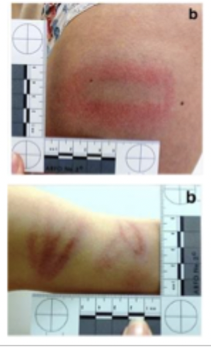 <p><strong>Tramline bruises:</strong><br>A <strong>pair of parallel bruises with pale skin in between</strong>, caused by <strong>impact with a cylindrical object</strong>.</p><p class="isSelectedEnd"></p><p class="isSelectedEnd"><strong>How they form:</strong></p><ul><li><p>The <strong>object compresses the skin in the centre</strong>, squeezing blood away (central pallor)</p></li><li><p><strong>Blood vessels rupture at the edges</strong>, creating <strong>two parallel bruises</strong></p></li><li><p>Often leaves a <strong>distinctive patterned injury</strong></p></li></ul><p class="isSelectedEnd"></p><p class="isSelectedEnd"><strong>Common causes:</strong></p><ul><li><p>Strikes from <strong>cylindrical objects</strong> (e.g., rods, sticks, batons)</p></li></ul><p class="isSelectedEnd"></p><p class="isSelectedEnd"><strong>Forensic significance:</strong></p><ul><li><p>Pattern may help <strong>compare the bruise with the suspected weapon</strong></p></li><li><p>Seen in cases of <strong>assault or child abuse</strong></p></li></ul><p></p>