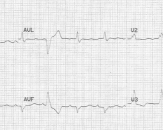 <p>Amyloidosis usually has a <strong>low-voltage QRS</strong>, while HCM usually has a <strong>high-voltage QRS</strong>.</p><p><strong>Simple reminder:</strong><br>Amyloidosis may look thick on echo but have low electrical voltage on EKG.</p>