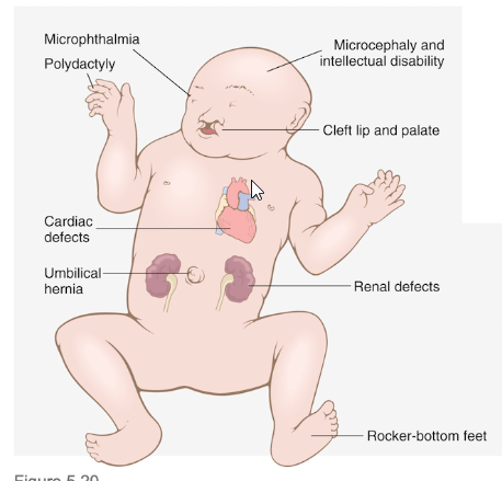 <p><span style="background-color: transparent;">Trisomy 13: Patau Syndrome</span></p><ul><li><p><span style="background-color: transparent;">Midline patterning failure -> Brain, Face, Heart malformation </span></p><ul><li><p><span style="background-color: transparent;">Holoprosencephaly</span></p></li><li><p><span style="background-color: transparent;">polydactyly</span></p></li></ul></li></ul><p></p>