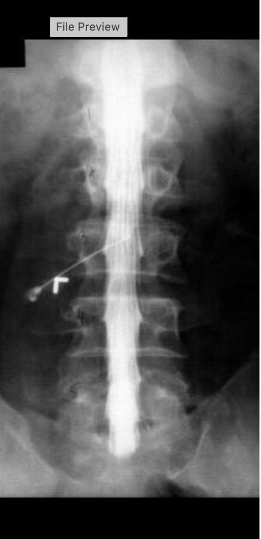 <p>what procedure is being performed on this image</p>