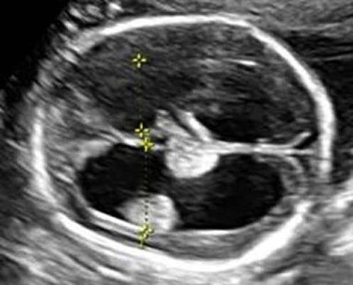 <ul><li><p>intracranial pressure vs none </p></li><li><p>caused by outflow obstruction </p></li><li><p>dangling choroid</p></li></ul><p></p>