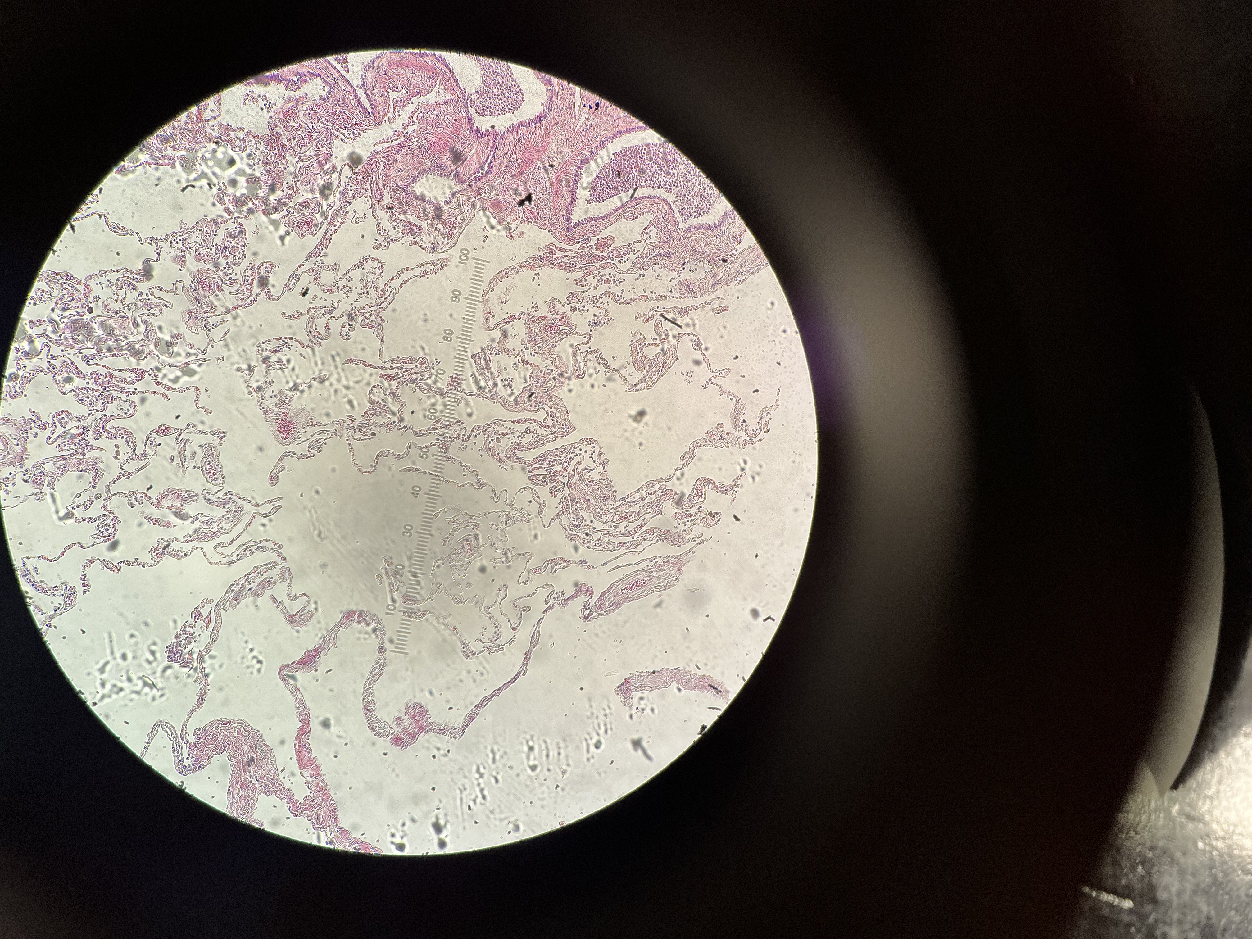 <p>Emphysema Lung (COPD: Chronic Obstructive Pulmonary Disease)</p><ul><li><p>alveoli compressed/collapsed, merged air spaces </p></li></ul><p></p>