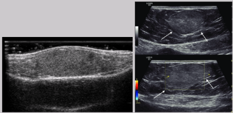<ul><li><p><span style="background-color: transparent;">Most common benign tumor of abdominal wall</span></p></li><li><p><span style="background-color: transparent;">Fatty and benign</span></p></li><li><p><span style="background-color: transparent;">Soft, palpable, painless</span></p></li><li><p><span style="background-color: transparent;">US appearance:&nbsp;</span></p><ul><li><p><span style="background-color: transparent;">Strongly echogenic - isoechoic</span></p></li><li><p><span style="background-color: transparent;">Difficult to distinguish from subcutaneous fat</span></p></li></ul></li></ul><p></p>