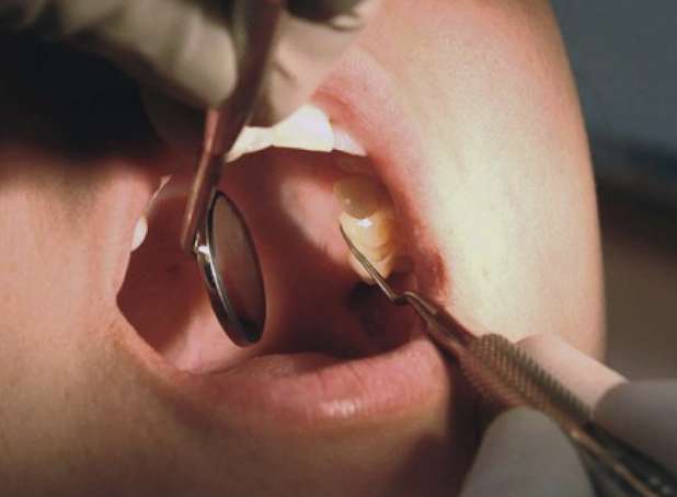 <p>Reflect light from dental light into mouth</p>