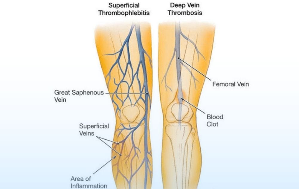 <p>TOWARD the surface of the body</p>